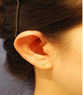 三大原理告诉你招风耳矫正的最佳方式是什么