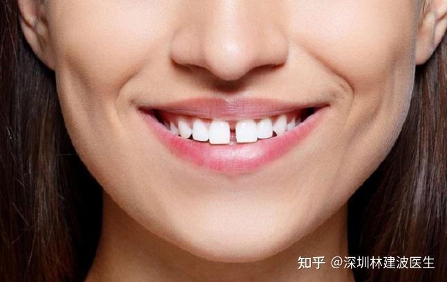 牙缝大容易导致牙齿脱落这是真的吗为什么会出现牙缝如果不及时修复