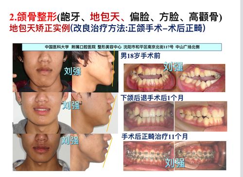 手术前及手术后面相和牙齿咬合关系的对比治疗结束时正面观面部对称