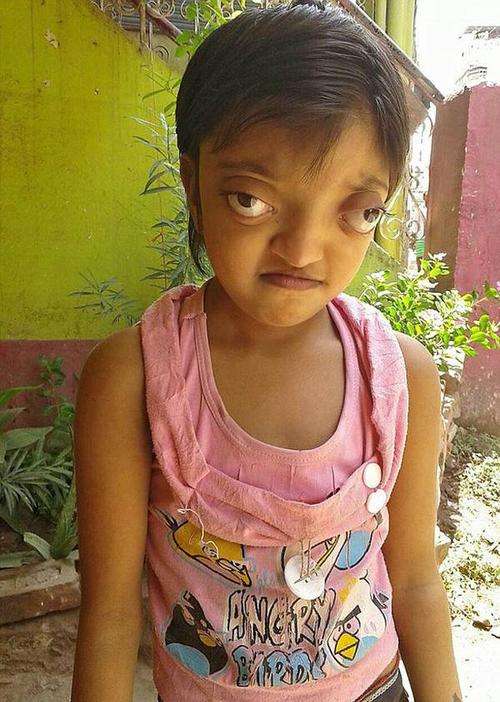印度女孩患罕见病长青蛙眼被称外星人图5