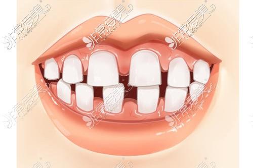 牙齿牙缝大牙齿稀疏怎么修复可以做矫正吗