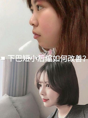 下巴短小后缩,如何改善?