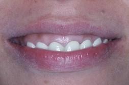 /p> p>理想的微笑是上切牙牙冠显露3/4 以上,牙龈