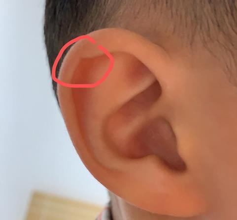 耳相耳骨反耳朵有缺口耳垂有横纹有什么说法